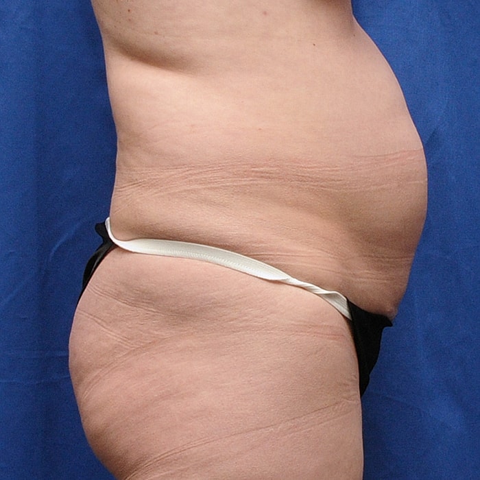 Abdominoplasty Before & After