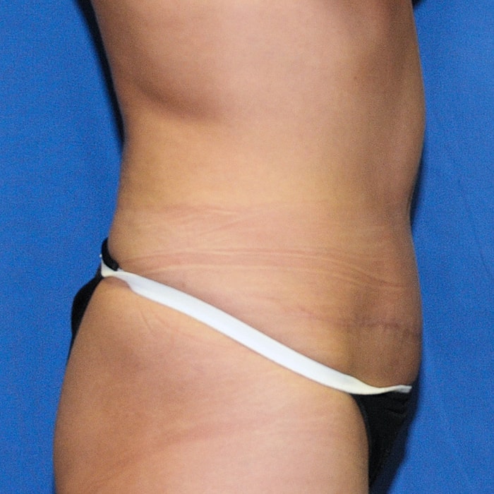 Abdominoplasty Before & After