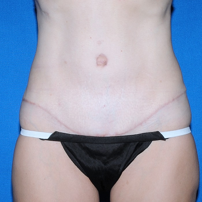 Abdominoplasty Before & After