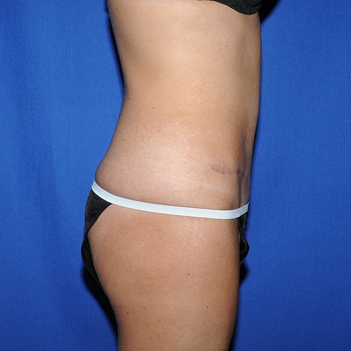 Abdominoplasty Before & After