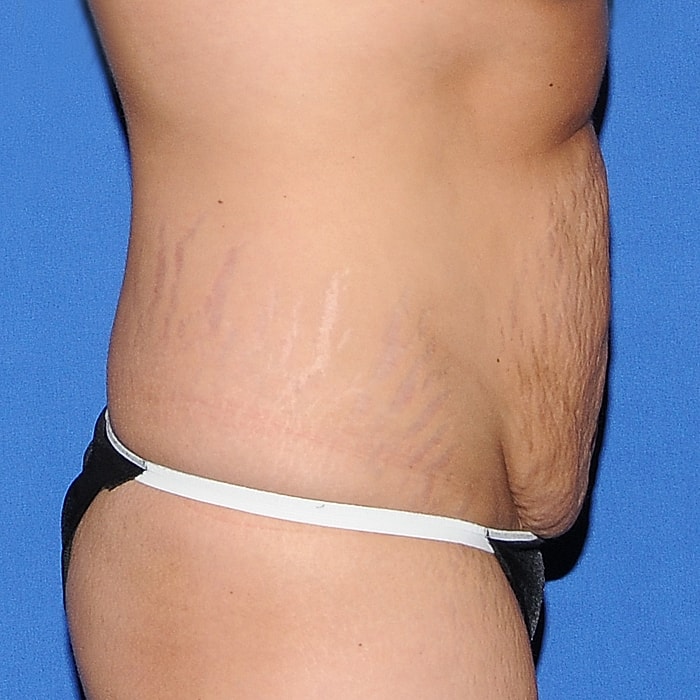 Abdominoplasty Before & After