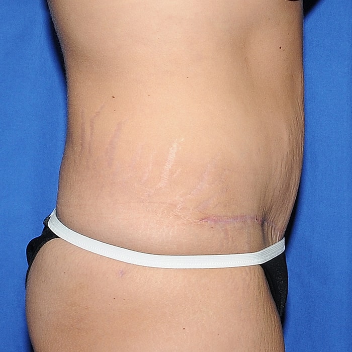 Abdominoplasty Before & After