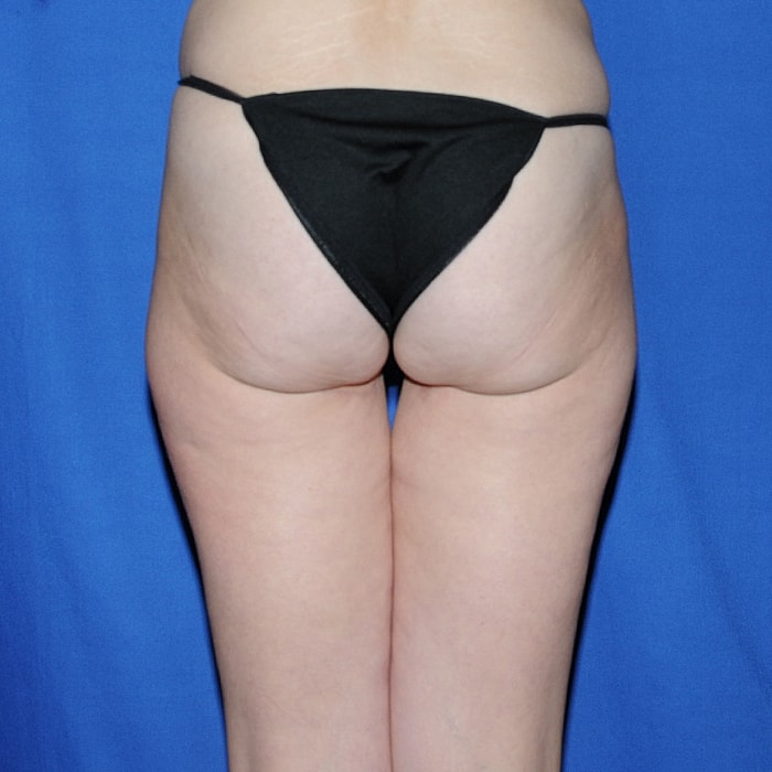 Thigh Lift Body Lift Massive Weight Loss Before & After