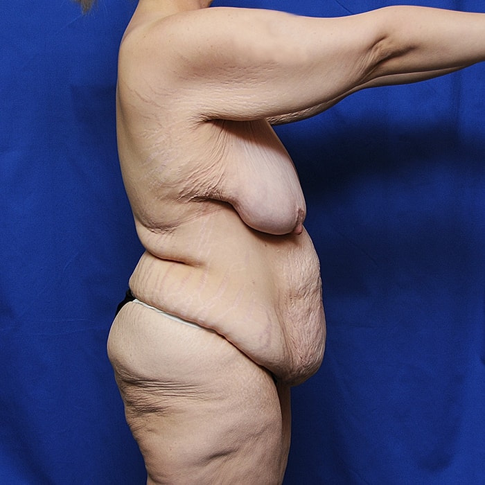 Thigh Lift Body Lift Massive Weight Loss Before & After