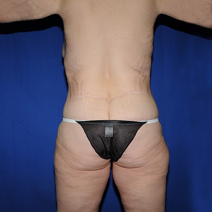 Thigh Lift Body Lift Massive Weight Loss Before & After