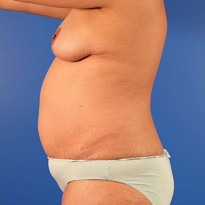 Bilateral DIEP 3D Nipple Tattoo Before & After