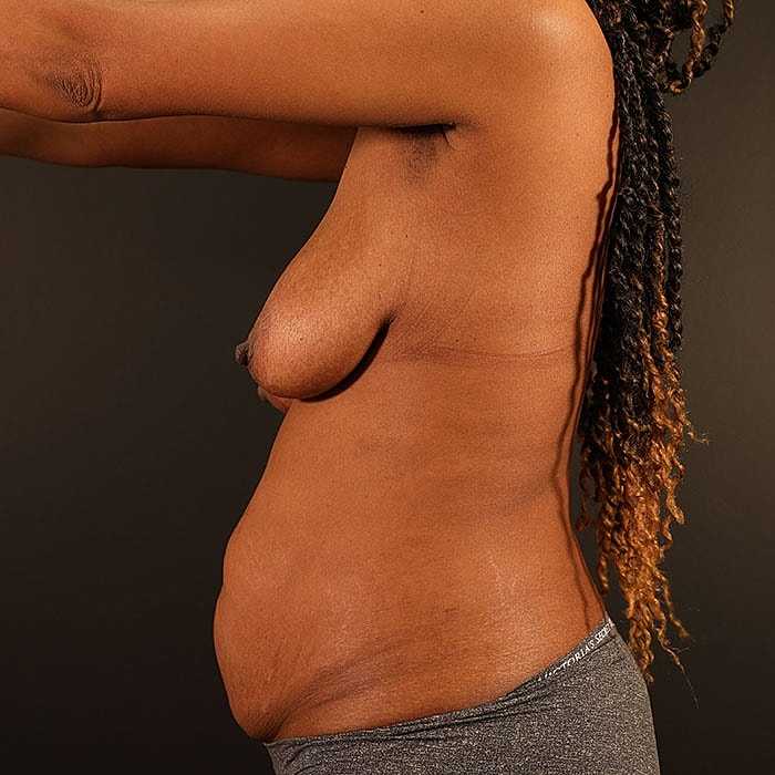 Bilateral DIEP 3d Nipple Tattoo Before & After