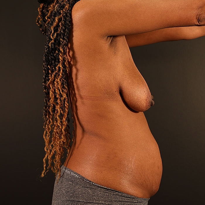 Bilateral DIEP 3d Nipple Tattoo Before & After