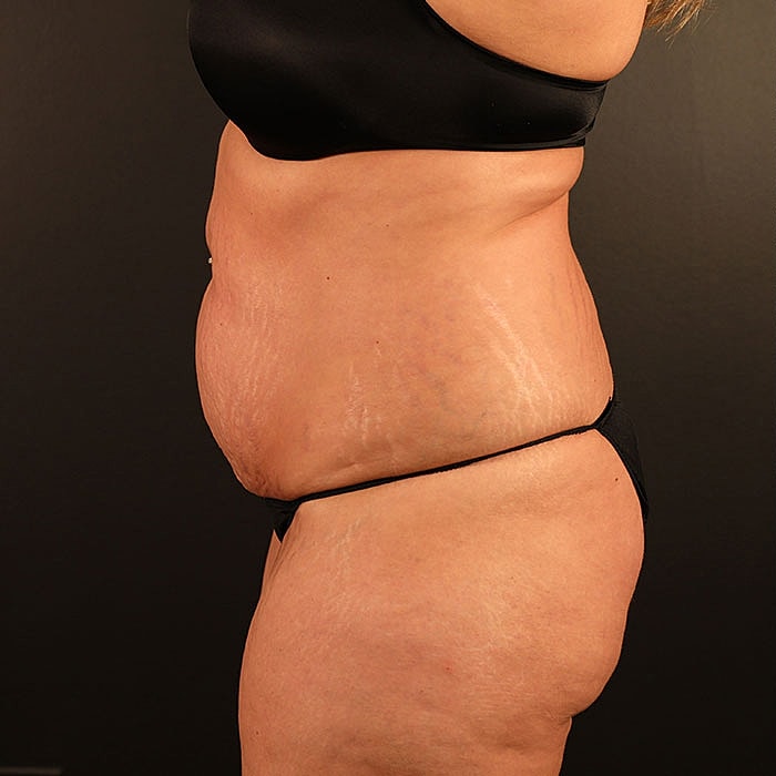 Weight Loss Surgery Before & After