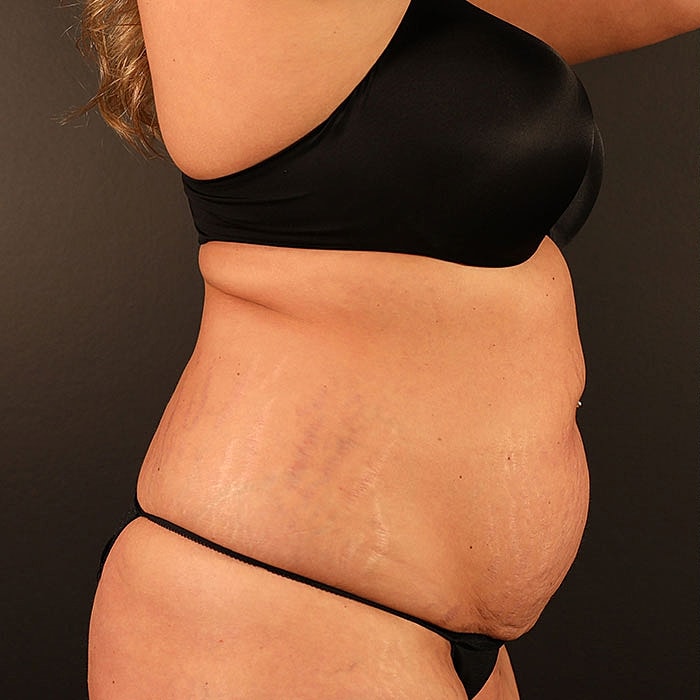 Weight Loss Surgery Before & After