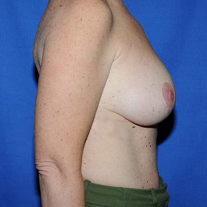 Breast Implant Exchange With Mastopexy Before & After