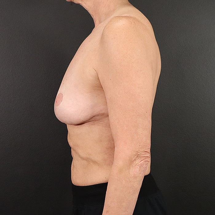 Breast Implant Removal With Mastopexy Before & After