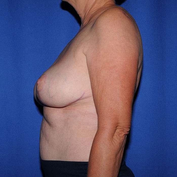 Breast Implant Removal With Mastopexy Before & After