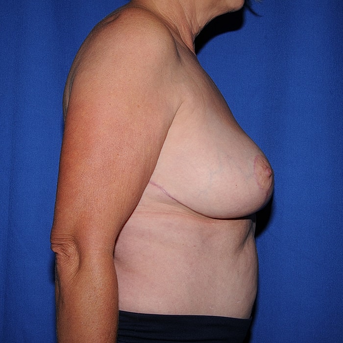 Breast Implant Removal With Mastopexy Before & After