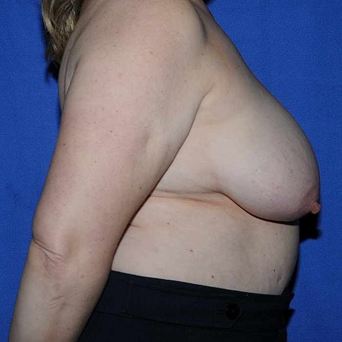Mastopexy Before & After