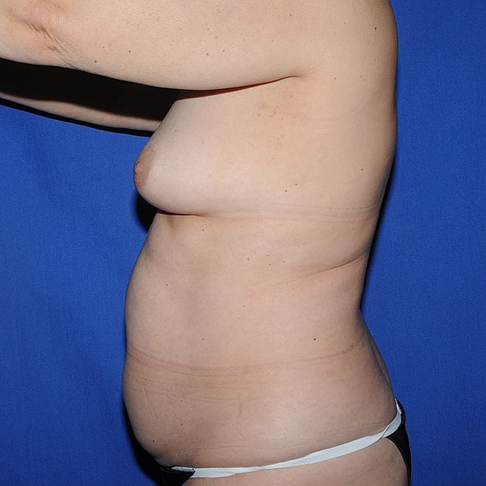 4 Flap Before & After