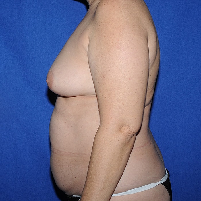 4 Flap Before & After