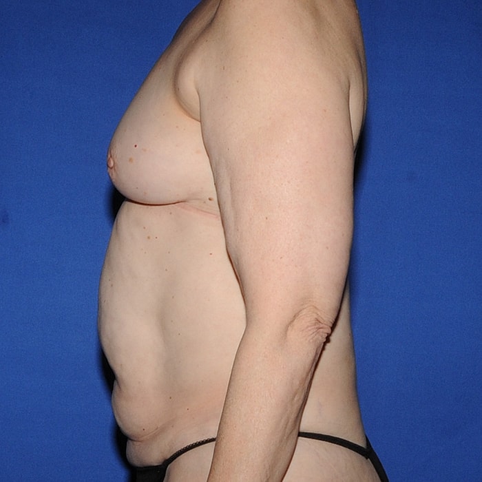 4 Flap Before & After