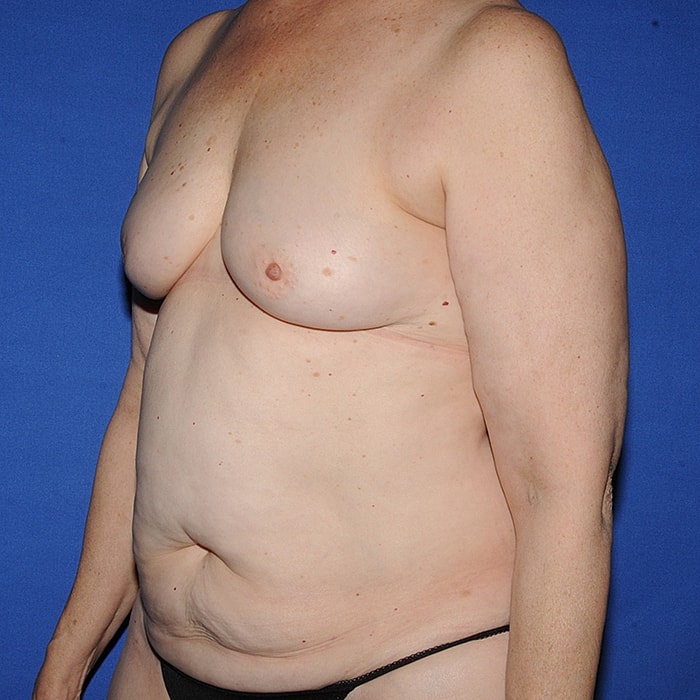 4 Flap Before & After