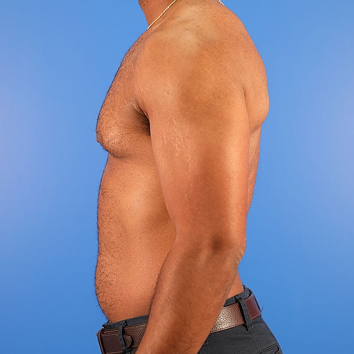 Gynecomastia Before & After