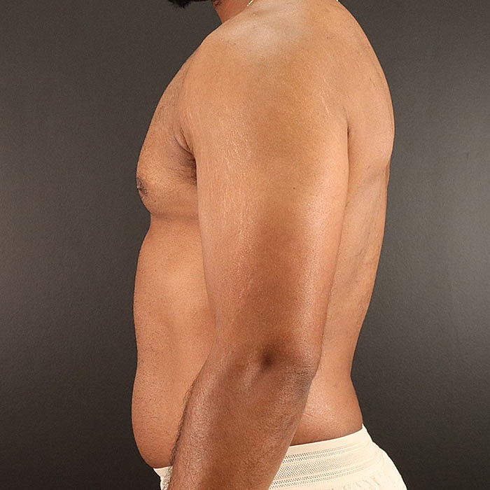 Gynecomastia Before & After