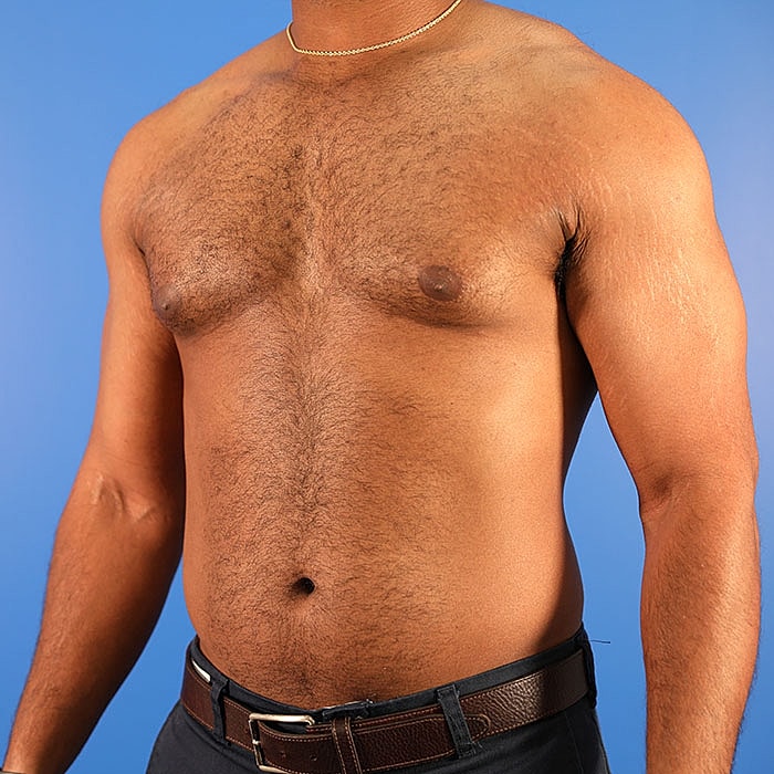 Gynecomastia Before & After