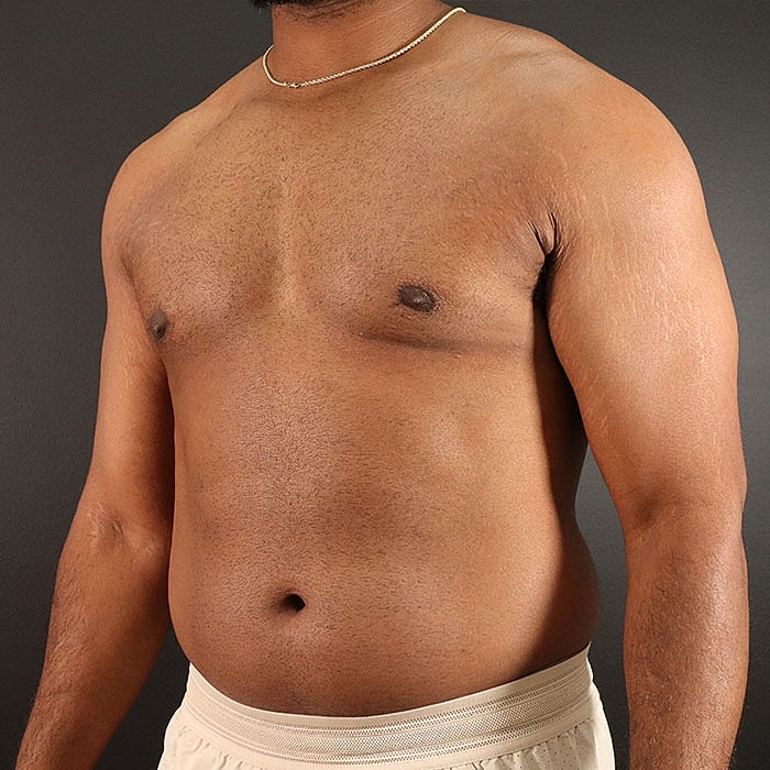 Gynecomastia Before & After