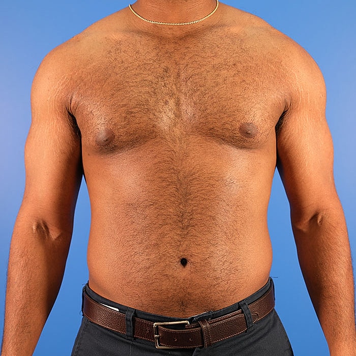 Gynecomastia Before & After