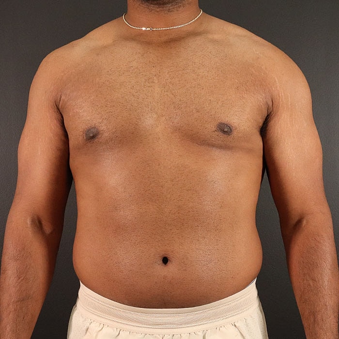 Gynecomastia Before & After