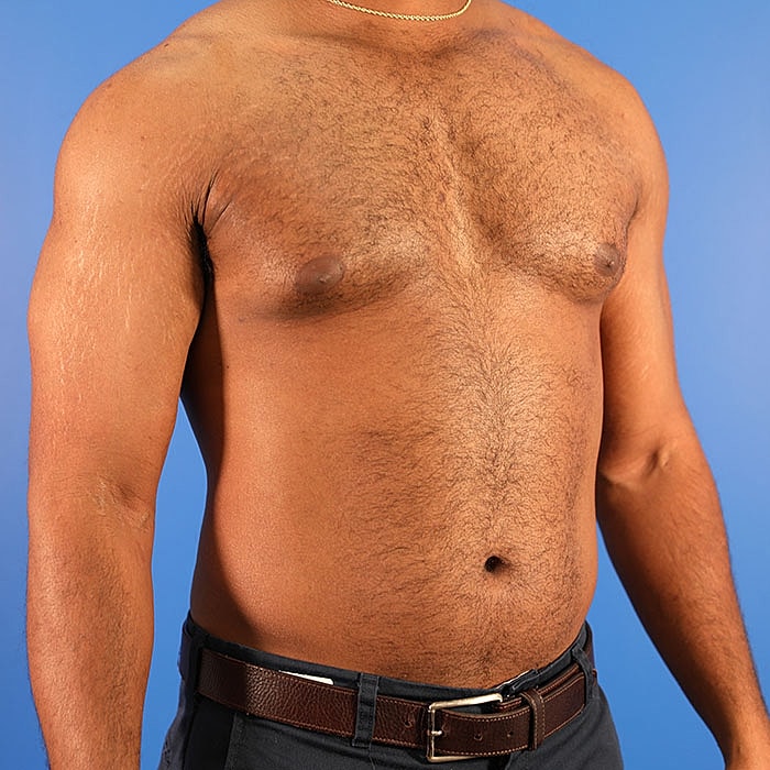 Gynecomastia Before & After