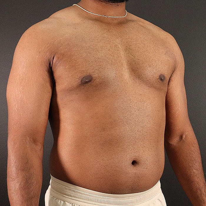 Gynecomastia Before & After