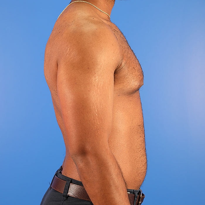 Gynecomastia Before & After