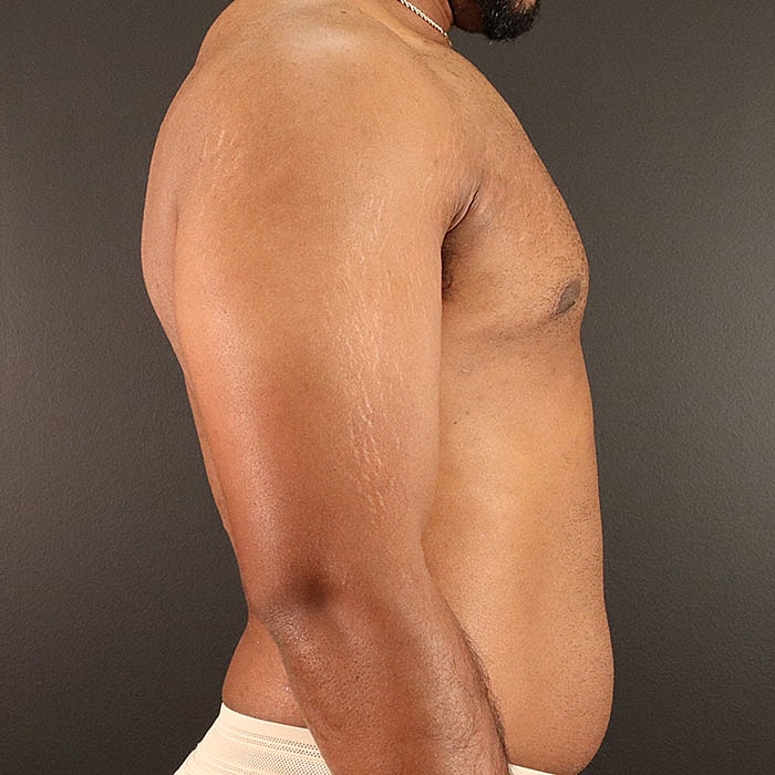 Gynecomastia Before & After