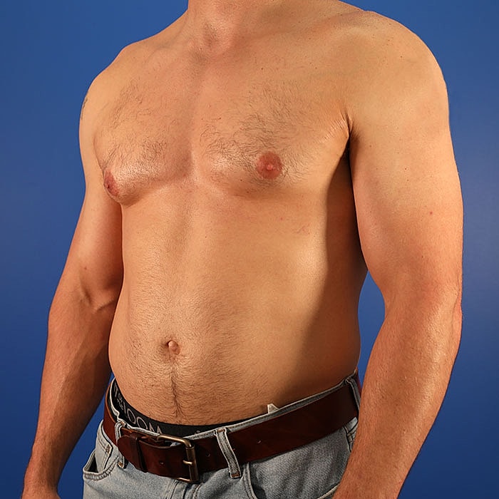 Gynecomastia Before & After