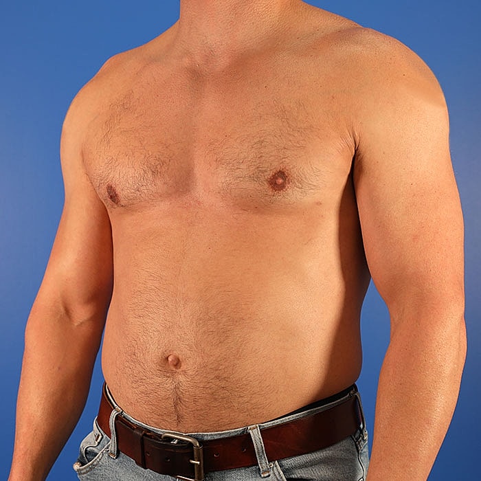 Gynecomastia Before & After