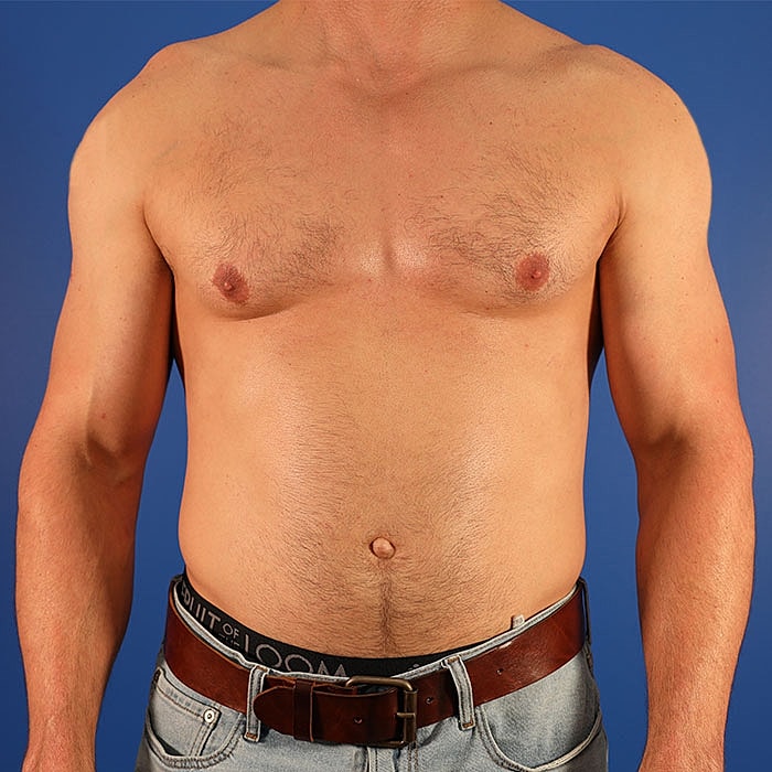 Gynecomastia Before & After