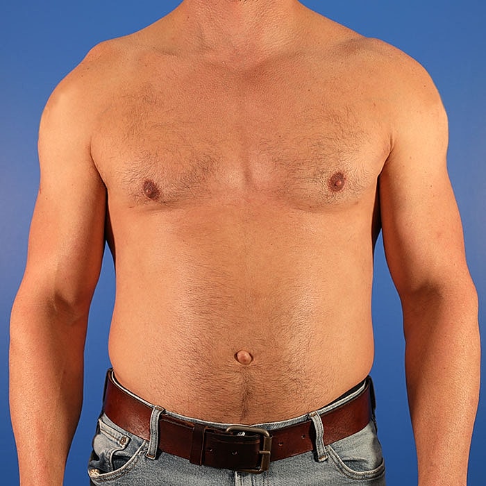 Gynecomastia Before & After