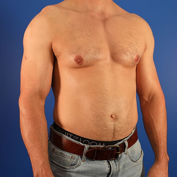 Gynecomastia Before & After
