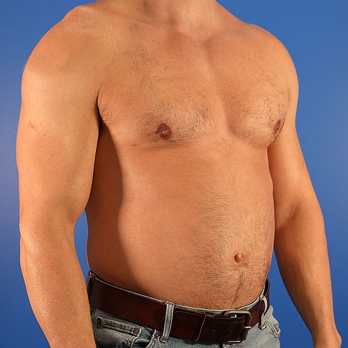 Gynecomastia Before & After