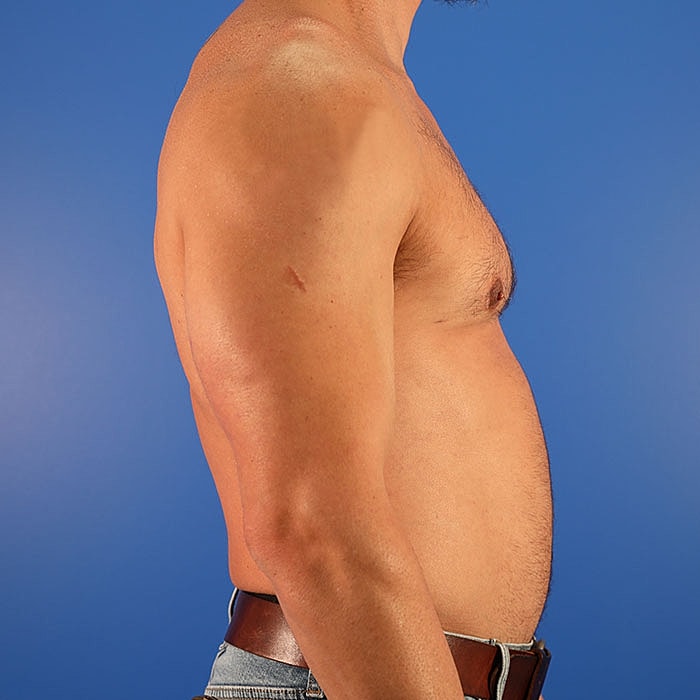 Gynecomastia Before & After