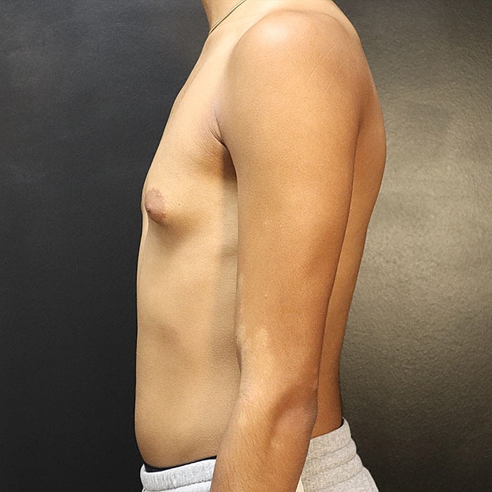 Gynecomastia Before & After