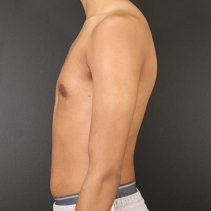 Gynecomastia Before & After