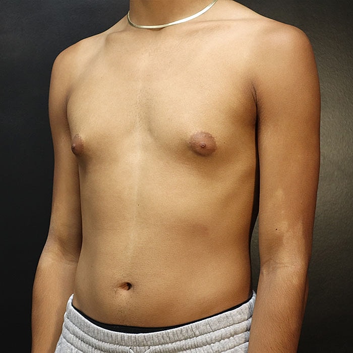 Gynecomastia Before & After