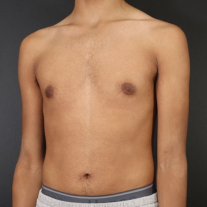 Gynecomastia Before & After
