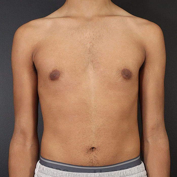 Gynecomastia Before & After