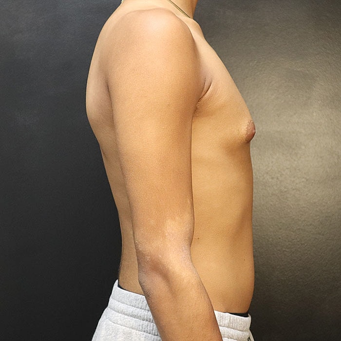 Gynecomastia Before & After