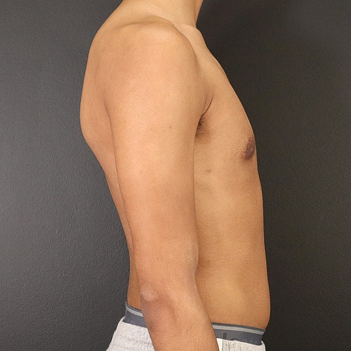 Gynecomastia Before & After