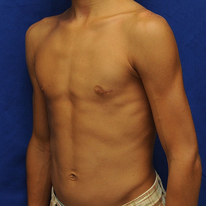 Gynecomastia Before & After
