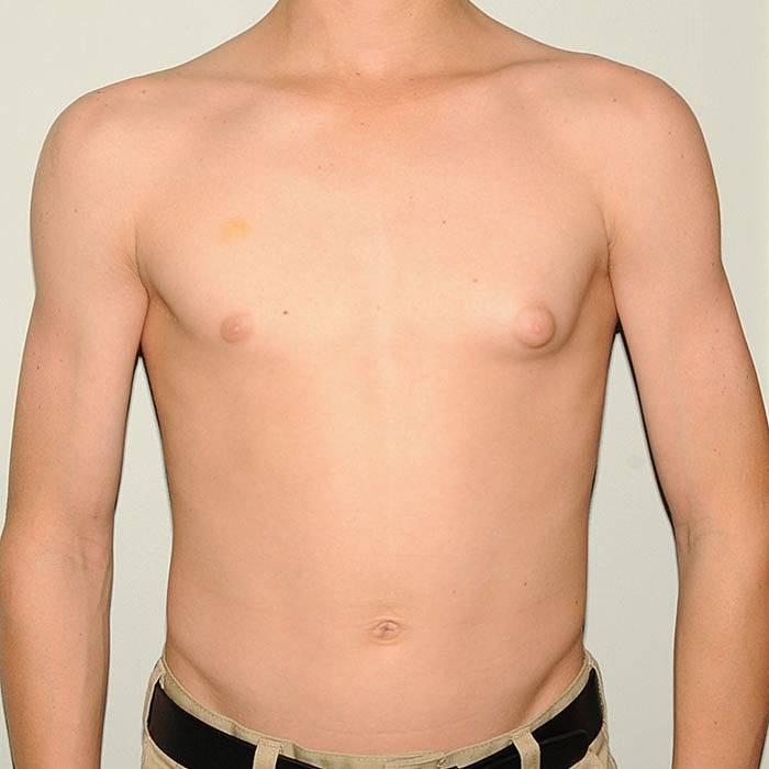 Gynecomastia Before & After