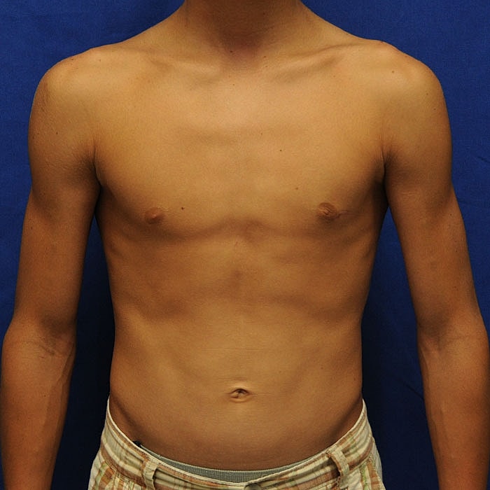 Gynecomastia Before & After